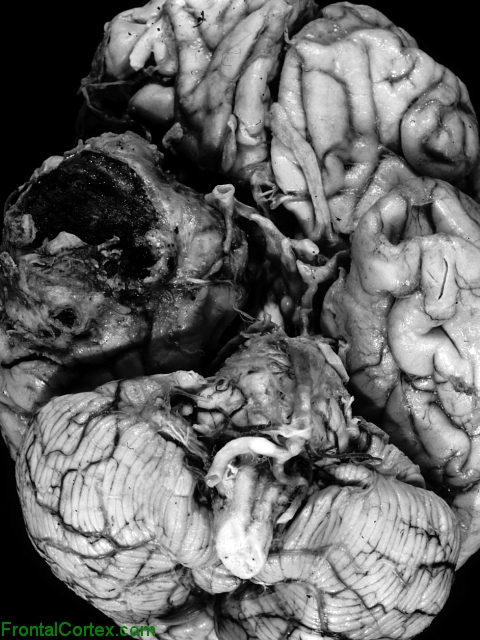 Giant MCA aneurysm, ventral surface of brain.